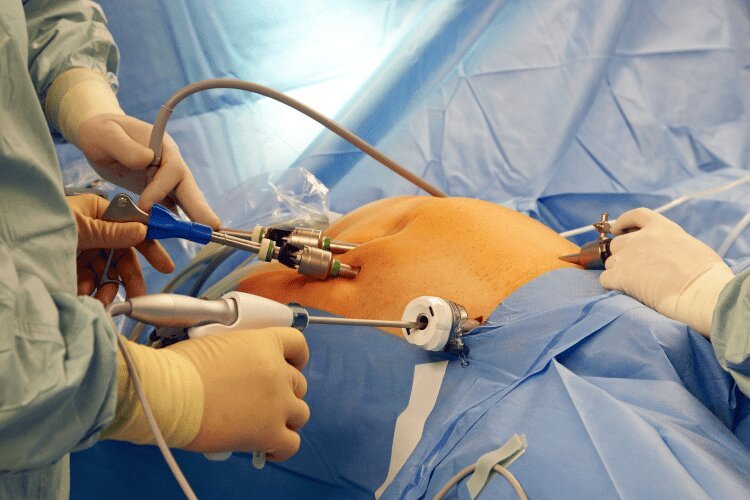 Surgical team performing a HIPEC procedure using Curotherm equipment